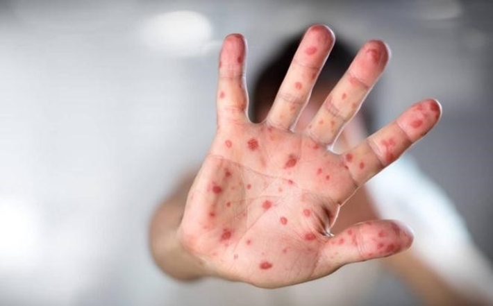Guidelines for diagnosis and treatment of hand, foot, and mouth disease in Vietnam